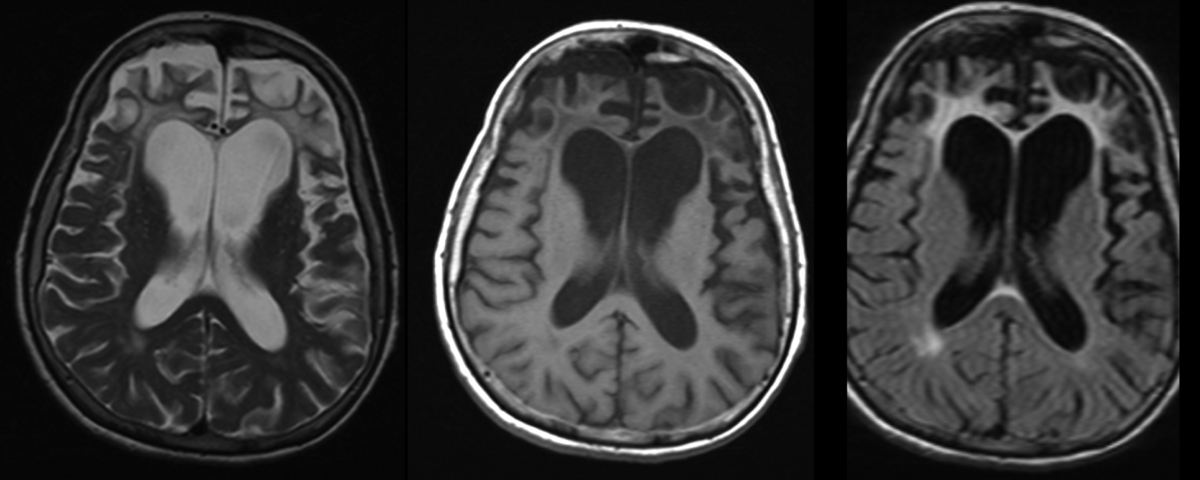alzheimer ve demans arasindaki farklar karsilastirma tablosu