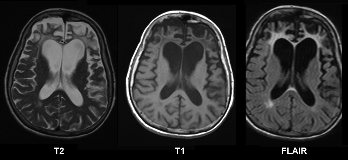 frontotemporal demans beynin on ve temporal lob etkileri