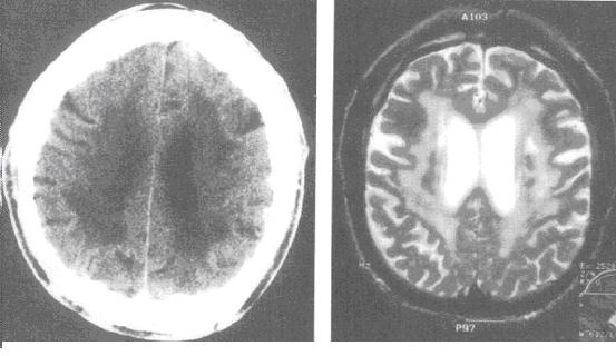 alzheimer ve vaskuler demans arasindaki farklari gosteren tablo